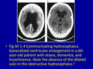 1 dilated cerebral ventricles Radiology | PPT