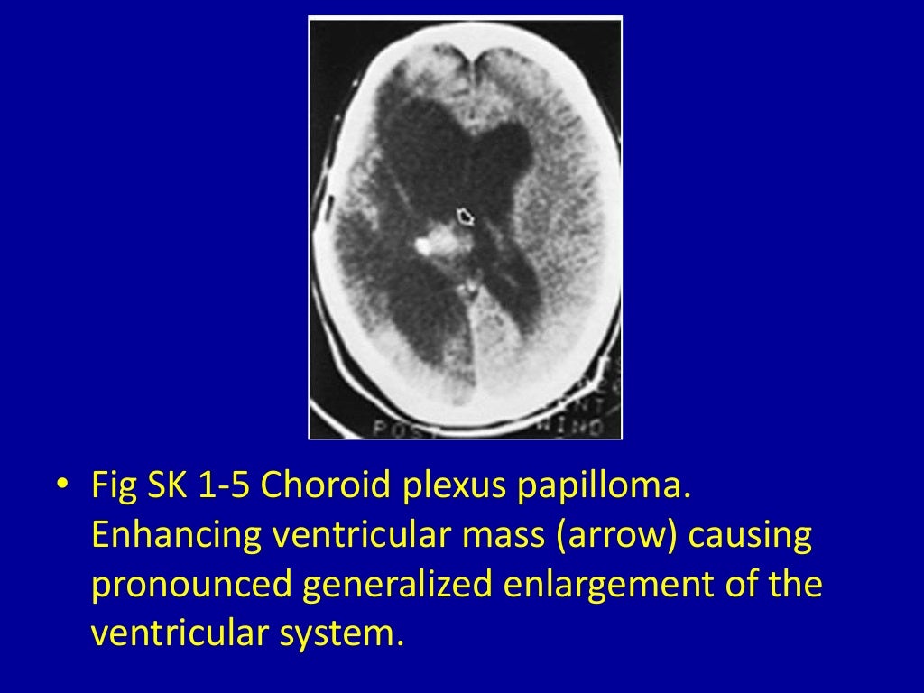 1 Dilated Cerebral Ventricles Radiology