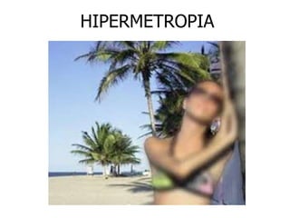 HIPERMETROPIA 
 