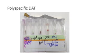 Negative Polyspecific Dat 1_Dr Jasmita Das Peripheral blood smear examination with Romanowsky ...