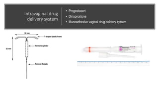 Intravaginal drug
delivery system
• Progestasert
• Dinoprostone
• Mucoadhesive vaginal drug delivery system
 