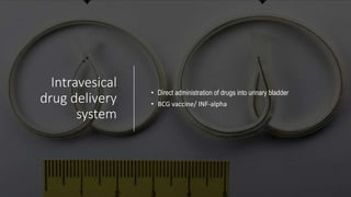 Intravesical
drug delivery
system
• Direct administration of drugs into urinary bladder
• BCG vaccine/ INF-alpha
 