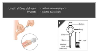 Urethral Drug delivery
system
• Self-microemulsifying DDS
• Erectile dysfunctions
 