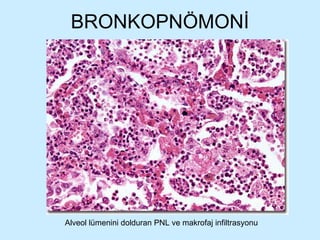 BRONKOPNÖMONİ Alveol lümenini dolduran PNL ve makrofaj infiltrasyonu 