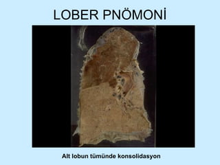 LOBER PNÖMONİ Alt lobun tümünde konsolidasyon 