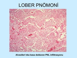 LOBER PNÖMONİ Alveolleri tıka basa dolduran PNL infiltrasyonu 