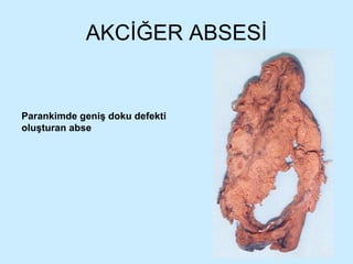 AKCİĞER ABSESİ Parankimde geniş doku defekti oluşturan abse 