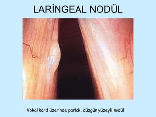LARİNGEAL NODÜL Vokal kord üzerinde parlak, düzgün yüzeyli nodül 