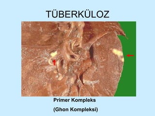 TÜBERKÜLOZ Primer Kompleks  (Ghon Kompleksi) 