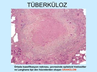 TÜBERKÜLOZ Ortada kazeifikasyon nekrozu, çevresinde epiteloid histiositler ve Langhans tipi dev hücrelerden oluşan  GRANÜLOM 