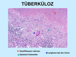 TÜBERKÜLOZ Kazeifikasyon nekrozu Epiteloid histiositler * * * * * * Langhans tipi dev hücre 