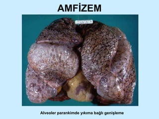 AMFİZEM Alveoler parankimde yıkıma bağlı genişleme 