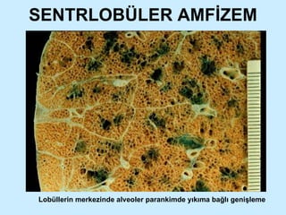 SENTRLOBÜLER AMFİZEM Lobüllerin merkezinde alveoler parankimde yıkıma bağlı genişleme 