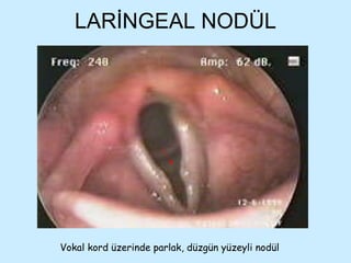LARİNGEAL NODÜL Vokal kord üzerinde parlak, düzgün yüzeyli nodül 