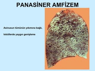 PANASİNER AMFİZEM Asinusun tümünün yıkımına bağlı,  lobüllerde yaygın genişleme 