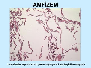 AMFİZEM İnteralveoler septumlardaki yıkıma bağlı geniş hava boşlukları oluşumu 