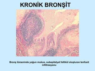 KRONİK BRONŞİT Bronş lümeninde yoğun mukus, subepitelyal follikül oluşturan lenfosit infiltrasyonu 