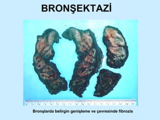 BRONŞEKTAZİ Bronşlarda belirgin genişleme ve çevresinde fibrozis 