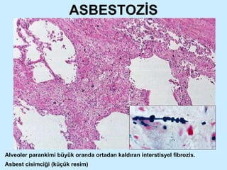 ASBESTOZİS Alveoler parankimi büyük oranda ortadan kaldıran interstisyel fibrozis.  Asbest cisimciği (küçük resim) 
