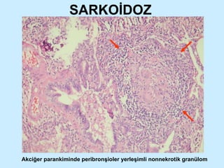 SARKOİDOZ Akciğer parankiminde peribronşioler yerleşimli nonnekrotik granülom 