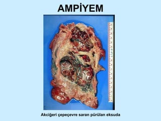 AMPİYEM Akciğeri çepeçevre saran pürülan eksuda 