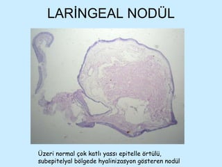 LARİNGEAL NODÜL Üzeri normal çok katlı yassı epitelle örtülü, subepitelyal bölgede hyalinizasyon gösteren nodül 