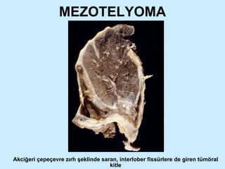 MEZOTELYOMA Akciğeri çepeçevre zırh şeklinde saran, interlober fissürlere de giren tümöral kitle 