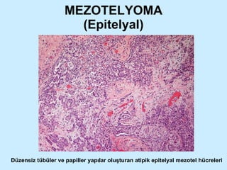 MEZOTELYOMA (Epitelyal) Düzensiz tübüler ve papiller yapılar oluşturan atipik epitelyal mezotel hücreleri 
