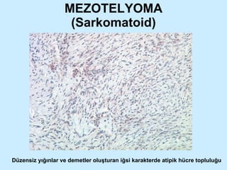 MEZOTELYOMA (Sarkomatoid) Düzensiz yığınlar ve demetler oluşturan iğsi karakterde atipik hücre topluluğu 