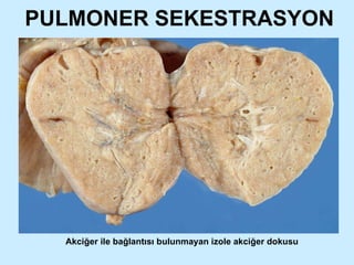 PULMONER SEKESTRASYON Akciğer ile bağlantısı bulunmayan izole akciğer dokusu 