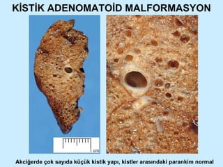 KİSTİK ADENOMATOİD MALFORMASYON Akciğerde çok sayıda küçük kistik yapı, kistler arasındaki parankim normal 
