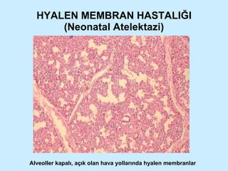 HYALEN MEMBRAN HASTALIĞI (Neonatal Atelektazi) Alveoller kapalı, açık olan hava yollarında hyalen membranlar 