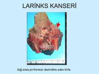 LARİNKS KANSERİ Sağ sinüs piriformisi destrükte eden kitle 