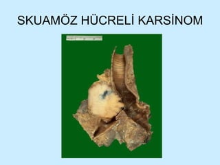 SKUAMÖZ HÜCRELİ KARSİNOM 