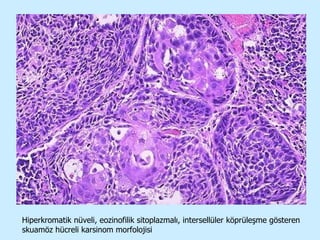 Hiperkromatik nüveli, eozinofilik sitoplazmalı, intersellüler köprüleşme gösteren skuamöz hücreli karsinom morfolojisi 