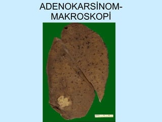 ADENOKARSİNOM-MAKROSKOPİ 