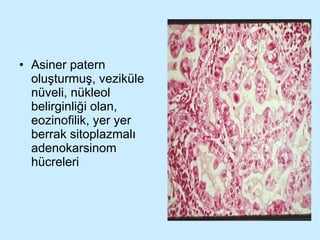 Asiner patern oluşturmuş, veziküle nüveli, nükleol belirginliği olan, eozinofilik, yer yer berrak sitoplazmalı adenokarsinom hücreleri 