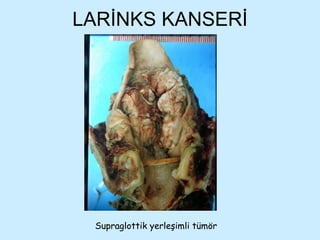 LARİNKS KANSERİ Supraglottik yerleşimli tümör 