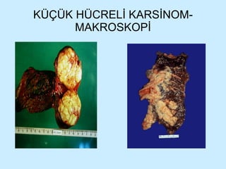 KÜÇÜK HÜCRELİ KARSİNOM- MAKROSKOPİ 