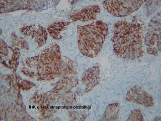 İHK olarak sinaptofizin pozitifliği 