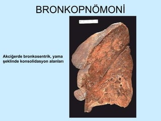 BRONKOPNÖMONİ Akciğerde bronkosentrik, yama şeklinde konsolidasyon alanları 