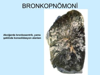 BRONKOPNÖMONİ Akciğerde bronkosentrik, yama şeklinde konsolidasyon alanları 