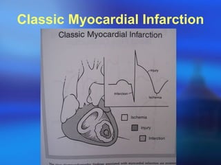 Classic Myocardial Infarction 