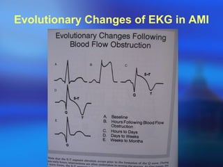 Evolutionary Changes of EKG in AMI 