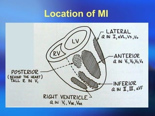 Location of MI  