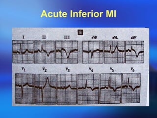Acute Inferior MI 