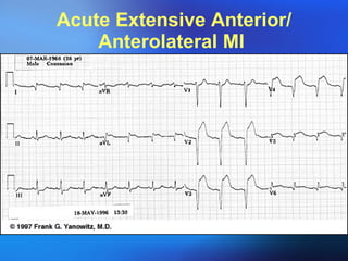 Acute Extensive Anterior/ Anterolateral MI  