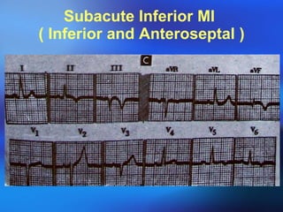 Subacute Inferior MI  ( Inferior and Anteroseptal ) 