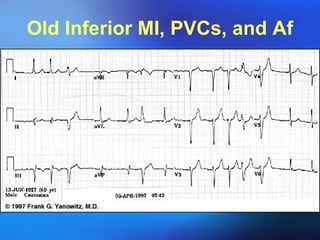 Old Inferior MI, PVCs, and Af 
