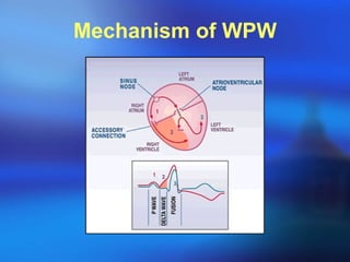 Mechanism of WPW 